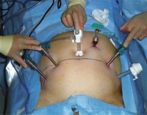 Izar Fabricación Deformación Robotic Prostatectomy – Endoglobe